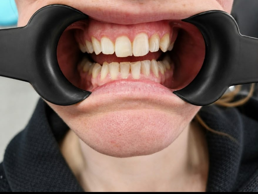 Invisalign before treatment at Welling Dental Studio