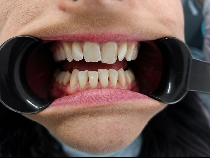 Invisalign before treatment at Welling Dental Studio