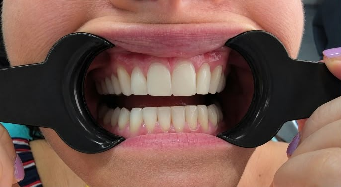 Invisalign after treatment at Welling Dental Studio