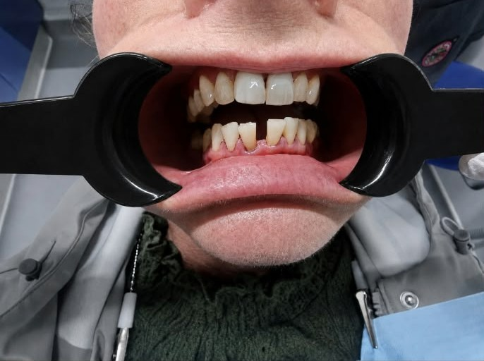 Invisalign before treatment at Welling Dental Studio