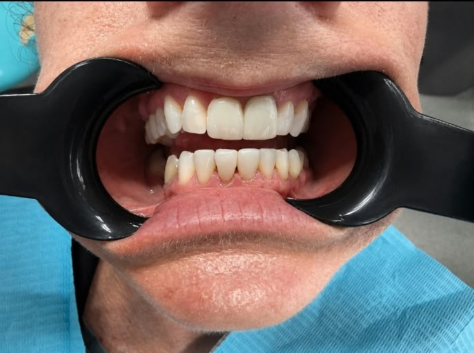 Invisalign after treatment at Welling Dental Studio