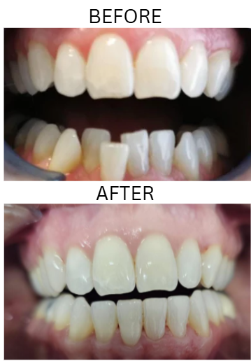 Before and after Invisalign treatment for Chloe Phillips