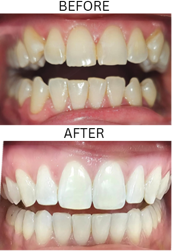 Before and after Invisalign treatment for Diella Salihu
