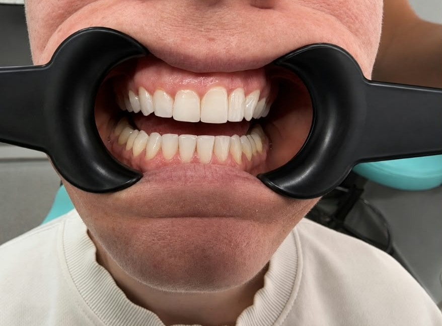 Invisalign after treatment at Welling Dental Studio