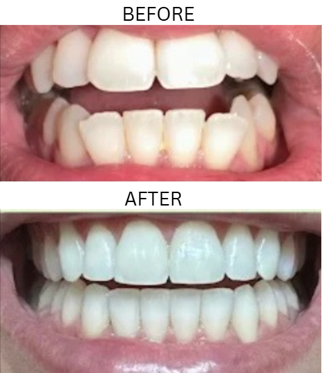 Before and after Invisalign treatment for Melissa Jones